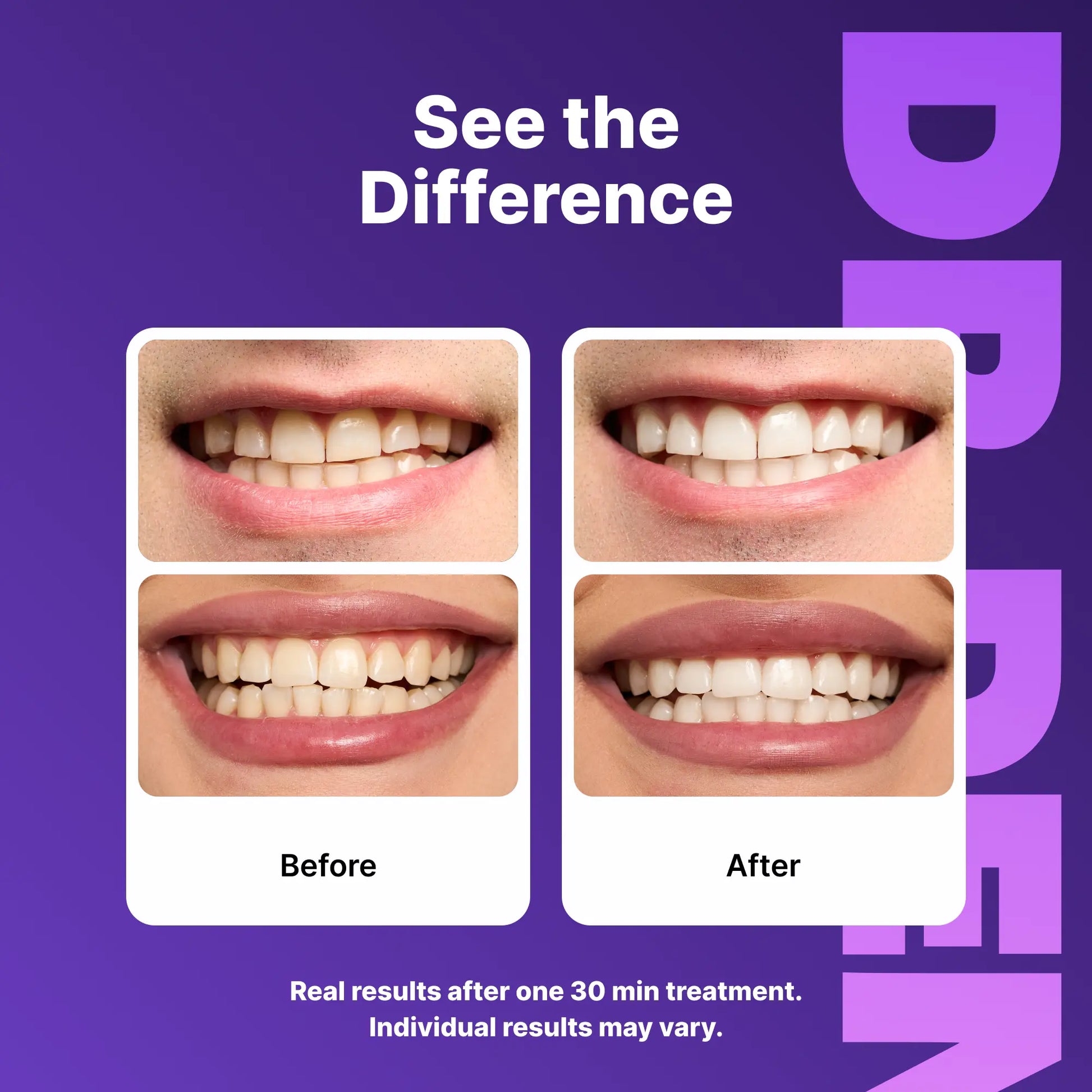 DRDENT Purple Teeth Whitening Strips - 7/21 Sessions - Enamel-Safe, Non-Sensitive, Peroxide-Free Formula